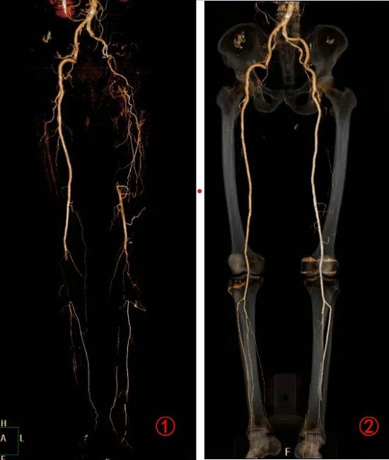 下肢动脉cta图片